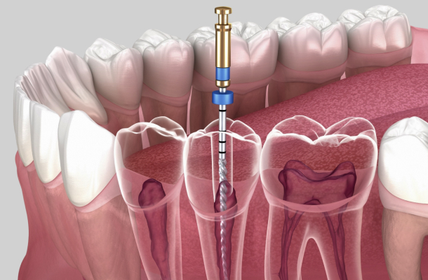 3D dental illustration showing dental implant placement procedure with cross-section anatomy of tooth and jawbone.