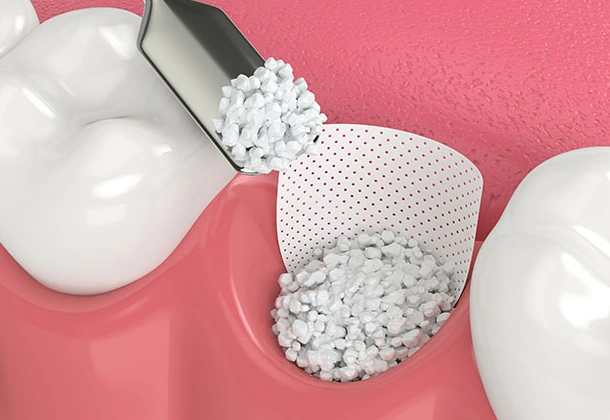 White spherical beads pouring from container into dental implant model against pink background.