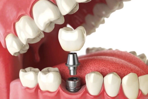 Dental implant diagram showing crown placement on titanium post in jawbone model.