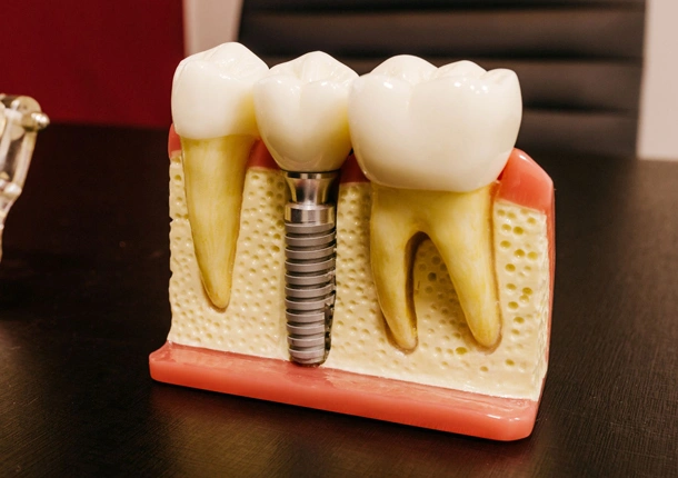 Dental implant model showing natural tooth, implant fixture, and crown on educational display.