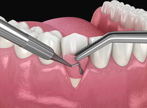 Dental extraction procedure showing forceps removing tooth from gum tissue model.