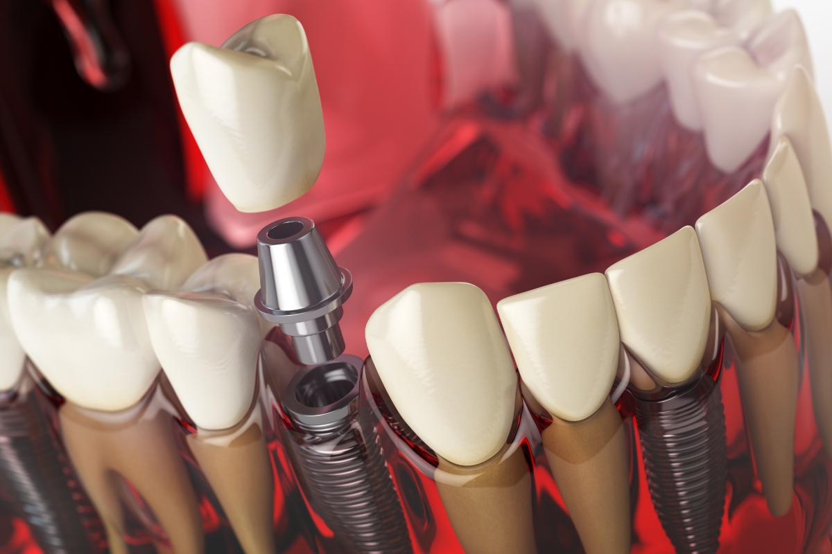 Is It Normal to Bleed from Your Nose After Dental Implants