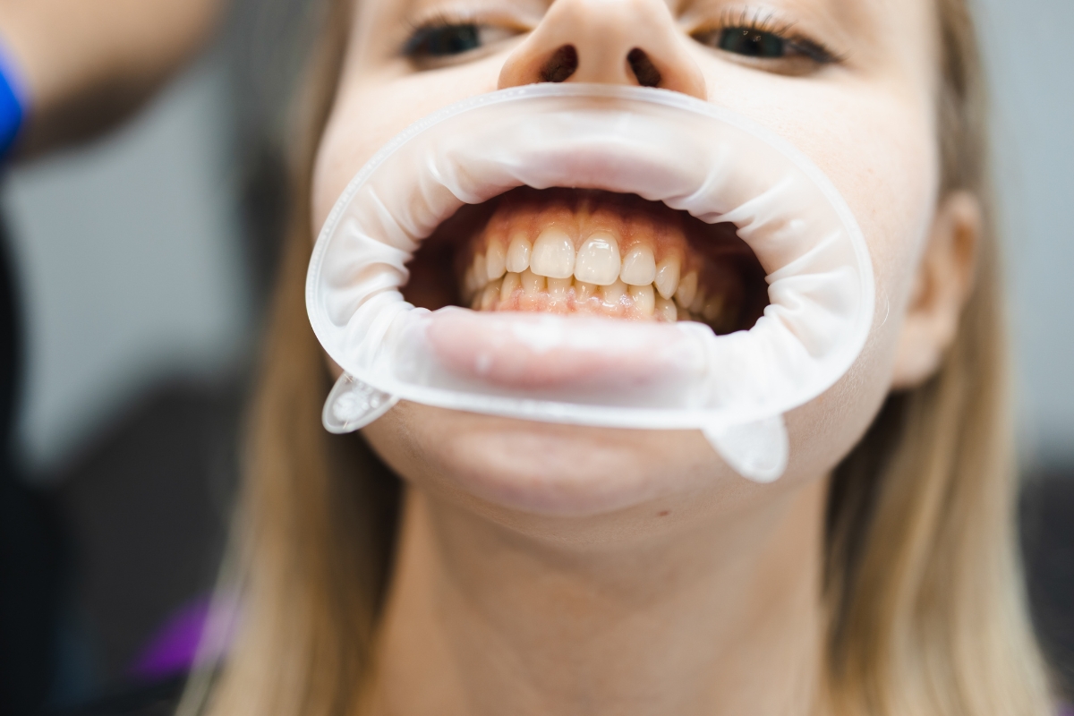 5 Signs You May Need a Periodontal Surgery